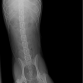 radiografia (cadera derecha rota)